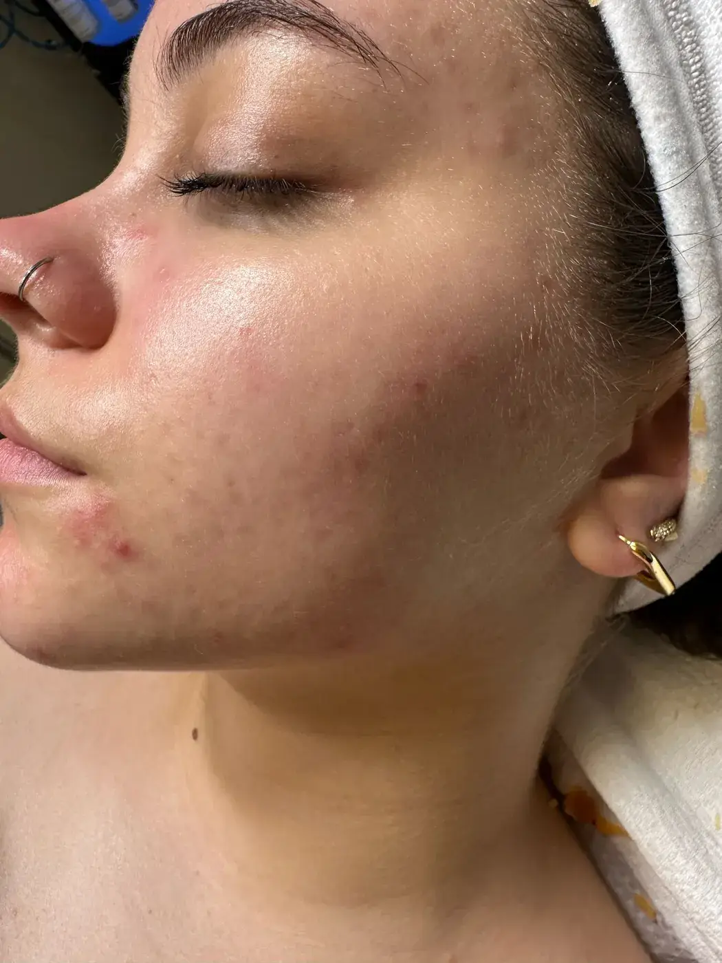 Acne after treatment at New Beauty