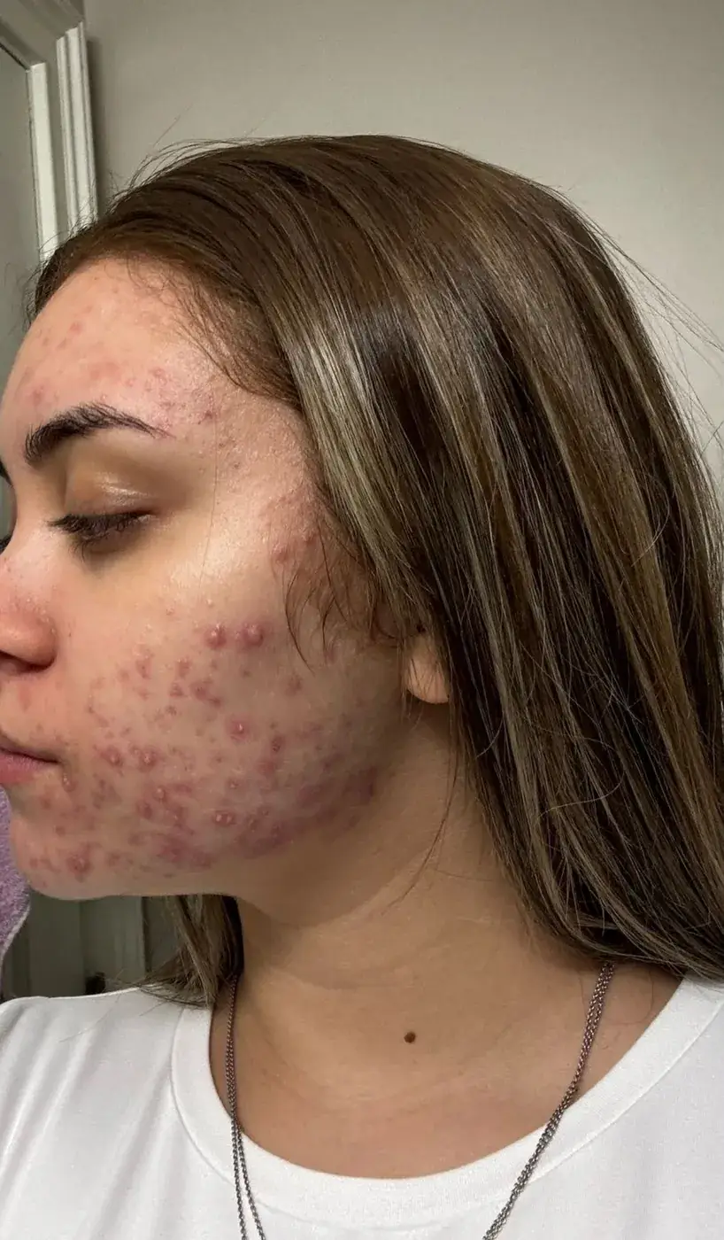 Acne before treatment at New Beauty