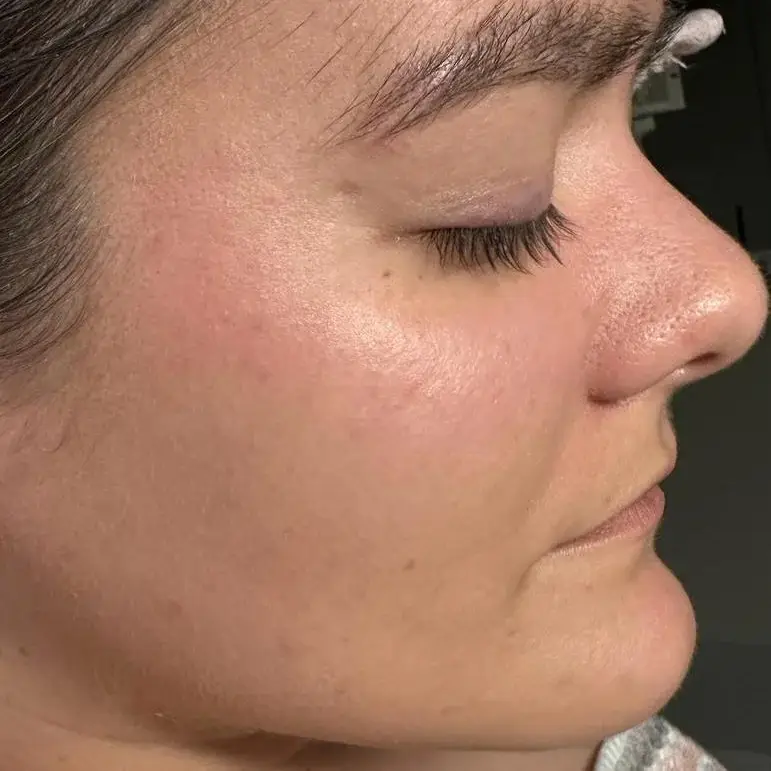 Acne after treatment at New Beauty