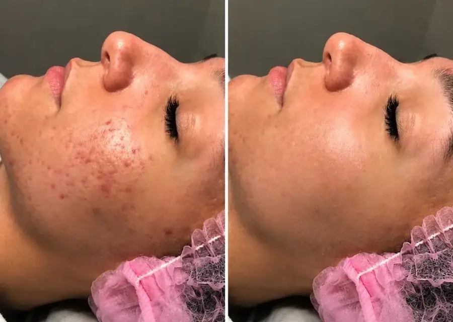 Acne before and after treatment at New Beauty