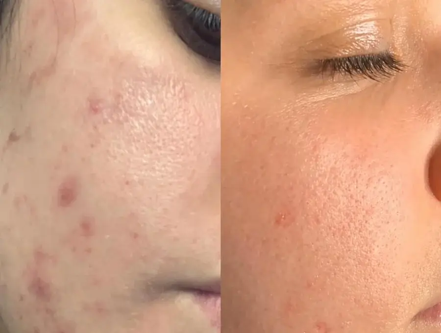 Acne before and after treatment at New Beauty