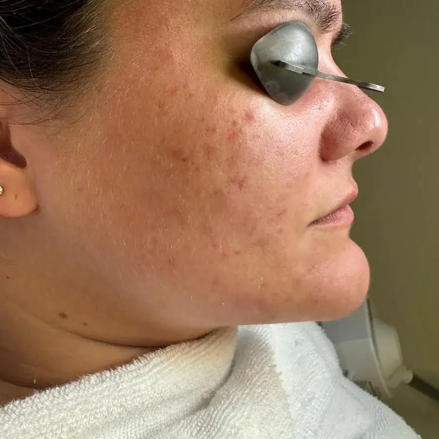 Acne before treatment at New Beauty
