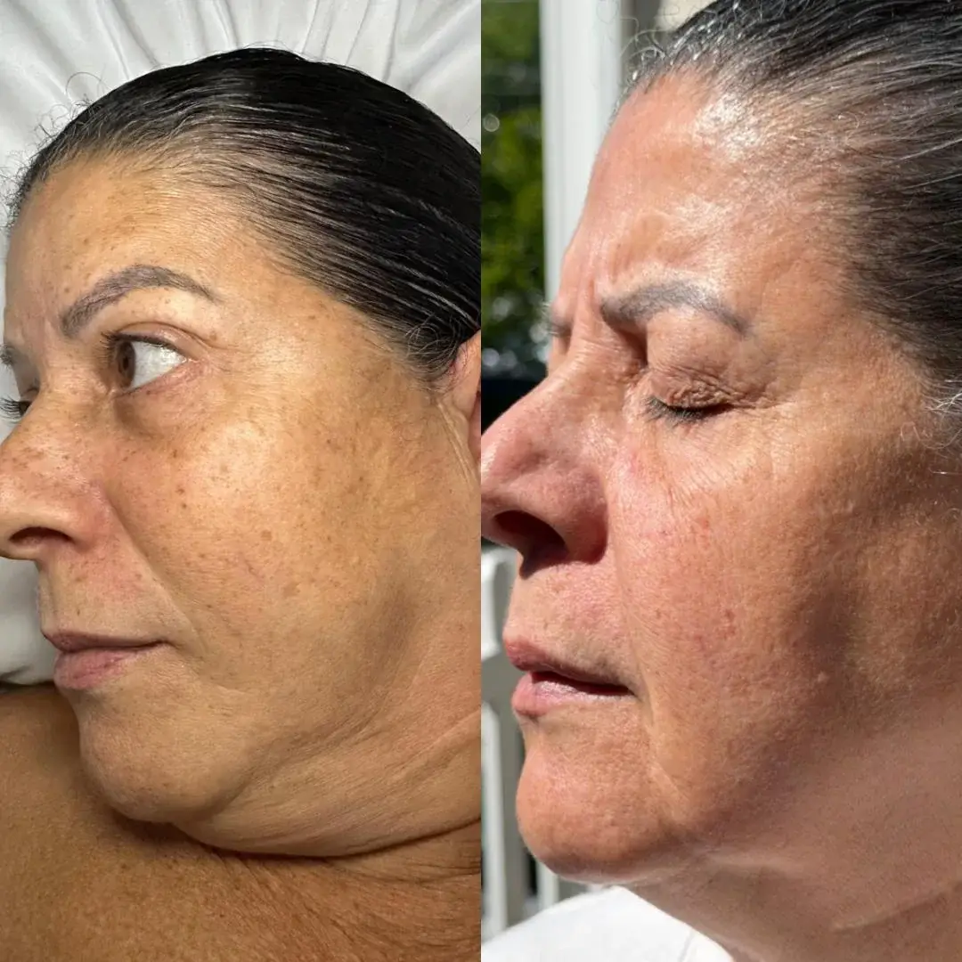 Hyperpigmentation treatment results at New Beauty