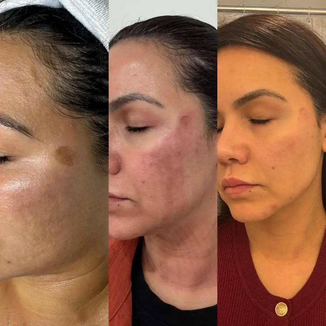 Melasma treatment results at New Beauty