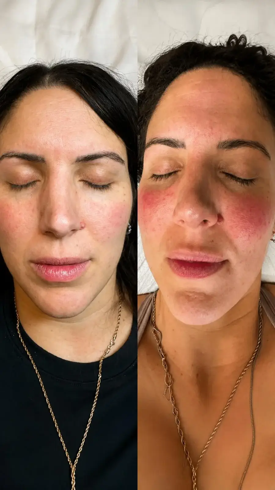 Redness and rosacea treatment results at New Beauty