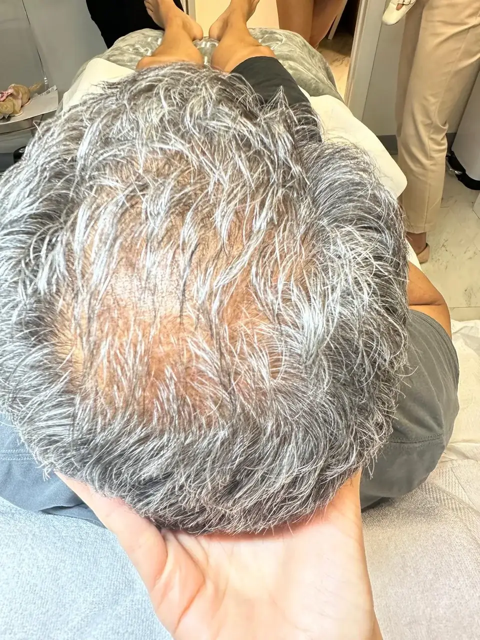 Scalp before treatment at New Beauty