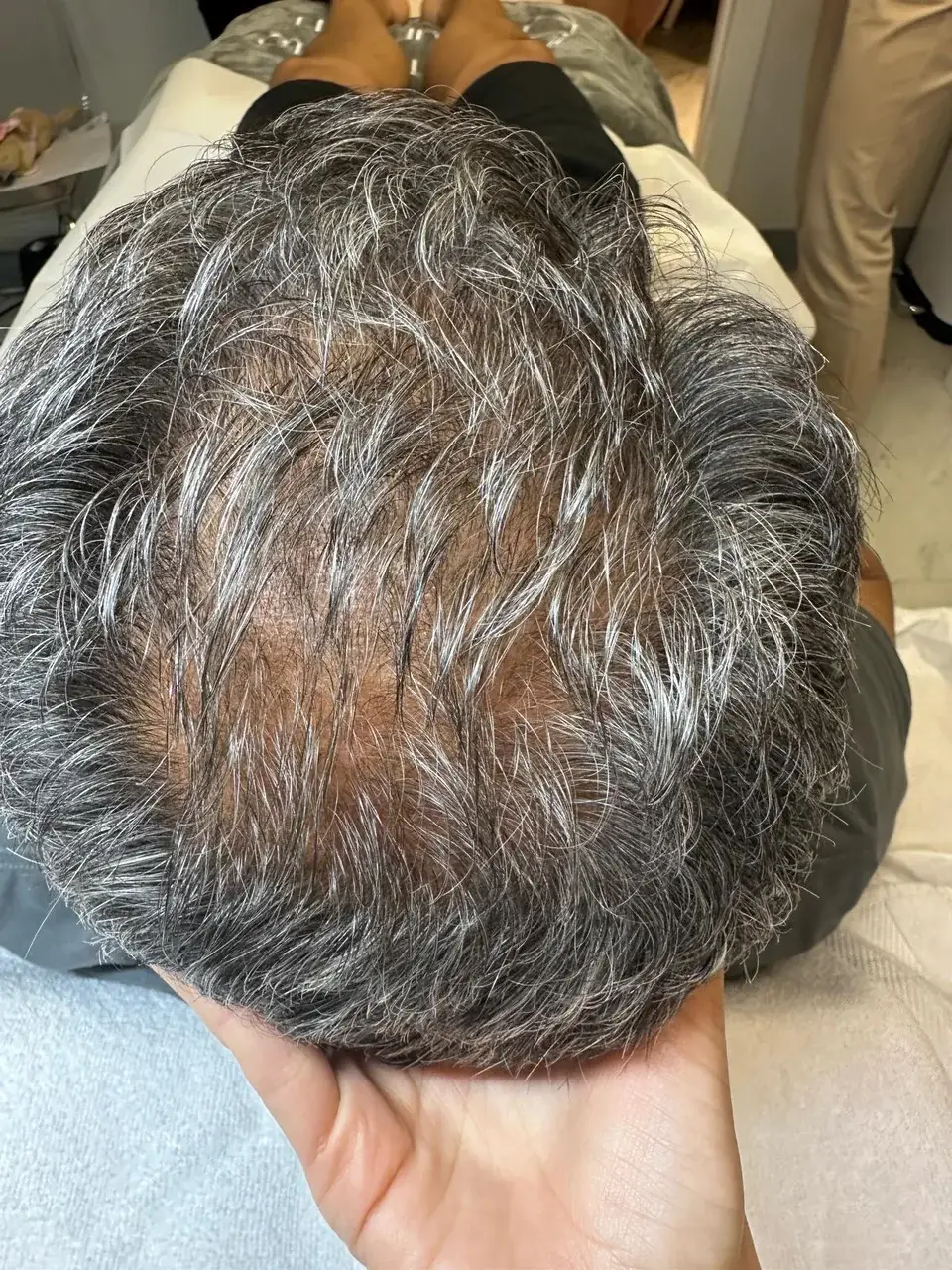 Scalp progress treatment at New Beauty