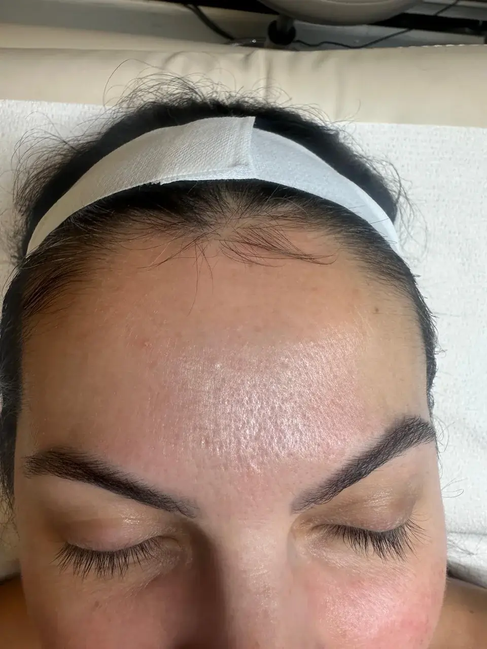 Acne scarring after treatment at New Beauty