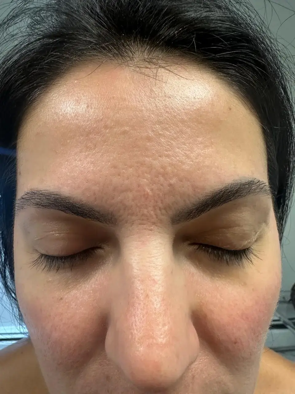 Acne scarring before treatment at New Beauty